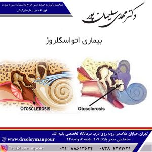 درمان بیماری اتواسکلروز - دکتر سلیمان پور